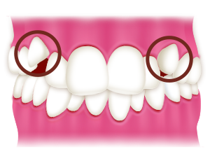 叢生の一種である八重歯