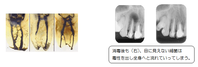歯性病巣感染について