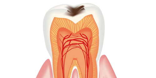 虫歯の知識