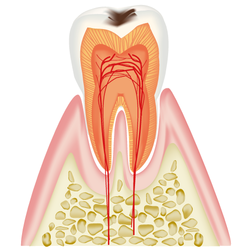 C1(エナメル質に限局した虫歯)