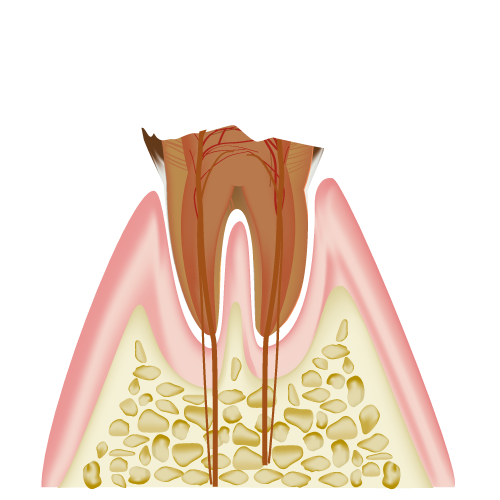 C4（歯の根にまで達した虫歯）