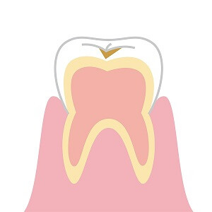 最初期の虫歯治療