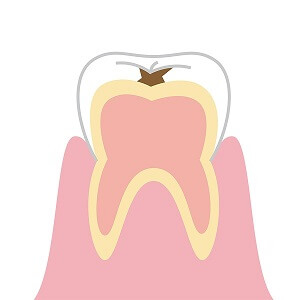 軽度の虫歯治療（エナメル質にまで進行した虫歯 ）