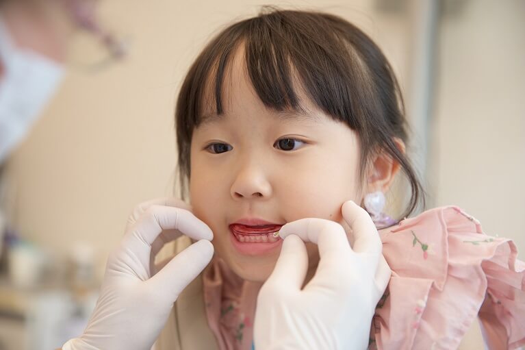 子供の八重歯の矯正治療