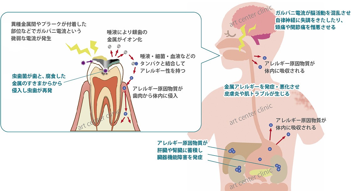 その症状、銀歯が原因かも！