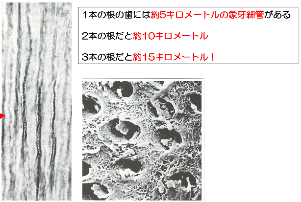 神経が無い歯は感染していま