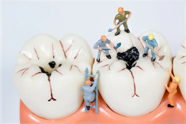 虫歯と治療イメージ