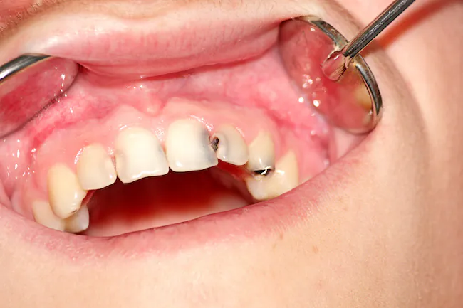 前歯の虫歯