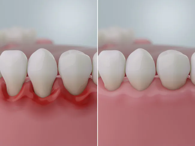 健康な歯ぐきと歯周病になった歯ぐきのイメージ