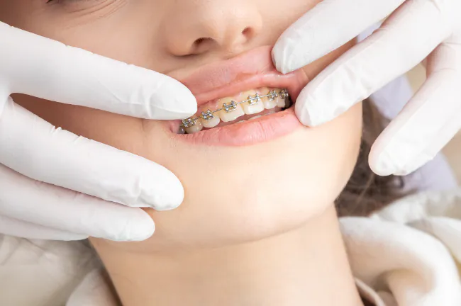 ワイヤーを装着した女性の口元