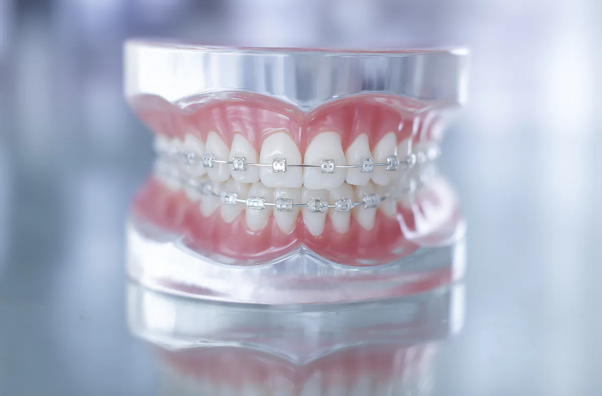 ワイヤー矯正している歯