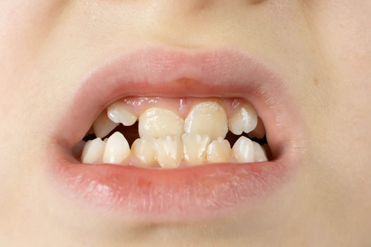 受け口の子供の口元