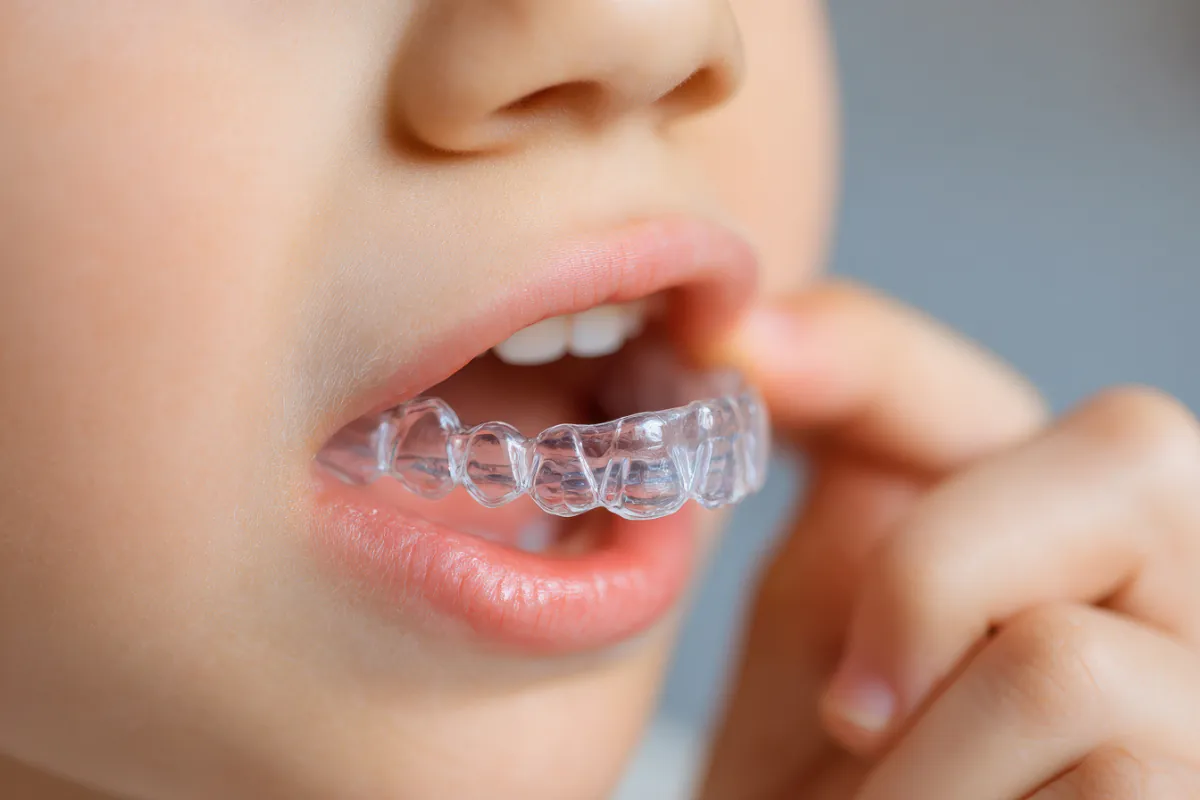 インビザライン・ファーストを装着する様子